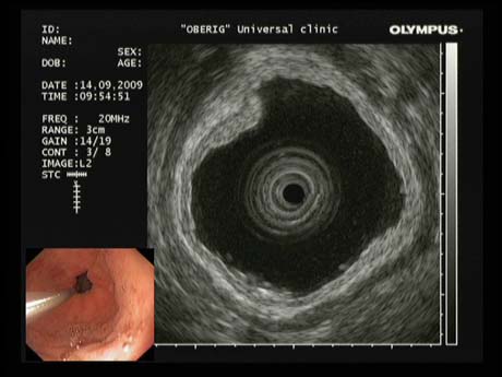 Тонкий эндоскопический ультразвуковой зонд в желудке (эндосонография). Визуализирован полип желудка и границы его прорастания.