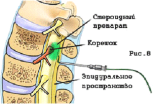 Міжхребцевий отвір