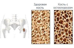 Остеопороз