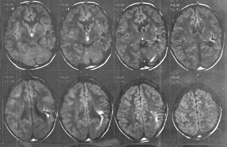 Рис. 1. МР-томография головного мозга при эпилепсии 