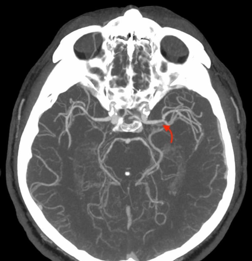 Successful revascularization 21 hours after the onset of the first manifestations of an ischemic stroke: a clinical case