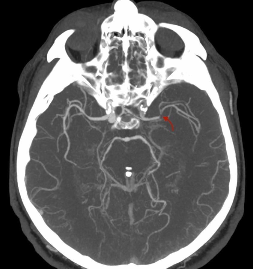 Successful revascularization 21 hours after the onset of the first manifestations of an ischemic stroke: a clinical case