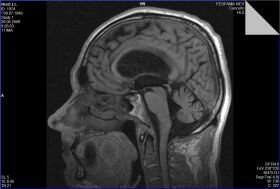 Нейрохирургия