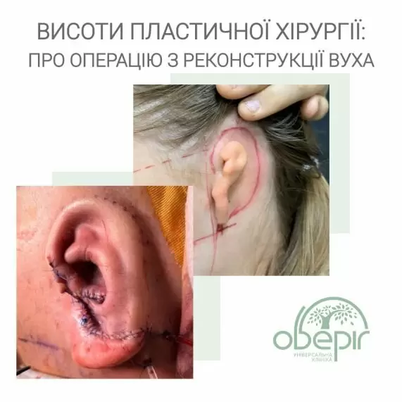 Уперше в Україні: лікар Дмитро Слоссер провів операцію з реконструкції вуха