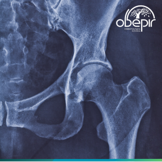 Коксартроз: коли стегно «скрипить» і болить