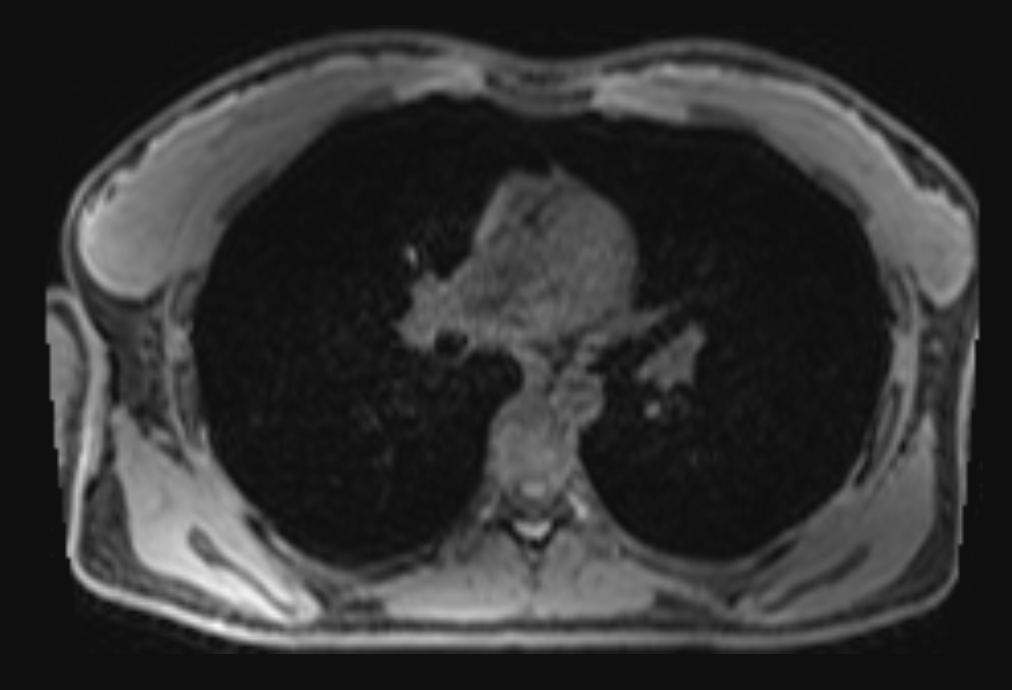 Магнітно-резонансна томографія (МРТ)