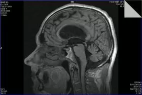 Нейрохірургія