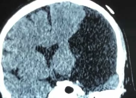 Арахноїдальні  кісти середньої черепної ямки головного мозку – симптоми, лікування, прогноз
