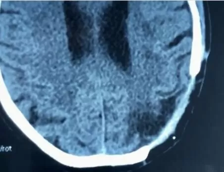 Дефекти кісток черепа